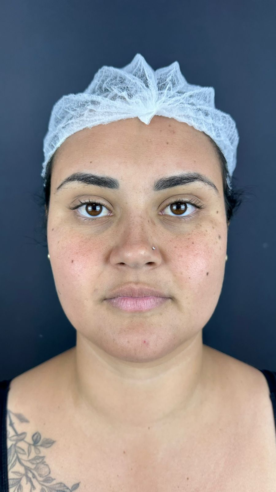 Antes del tratamiento de armonización facial