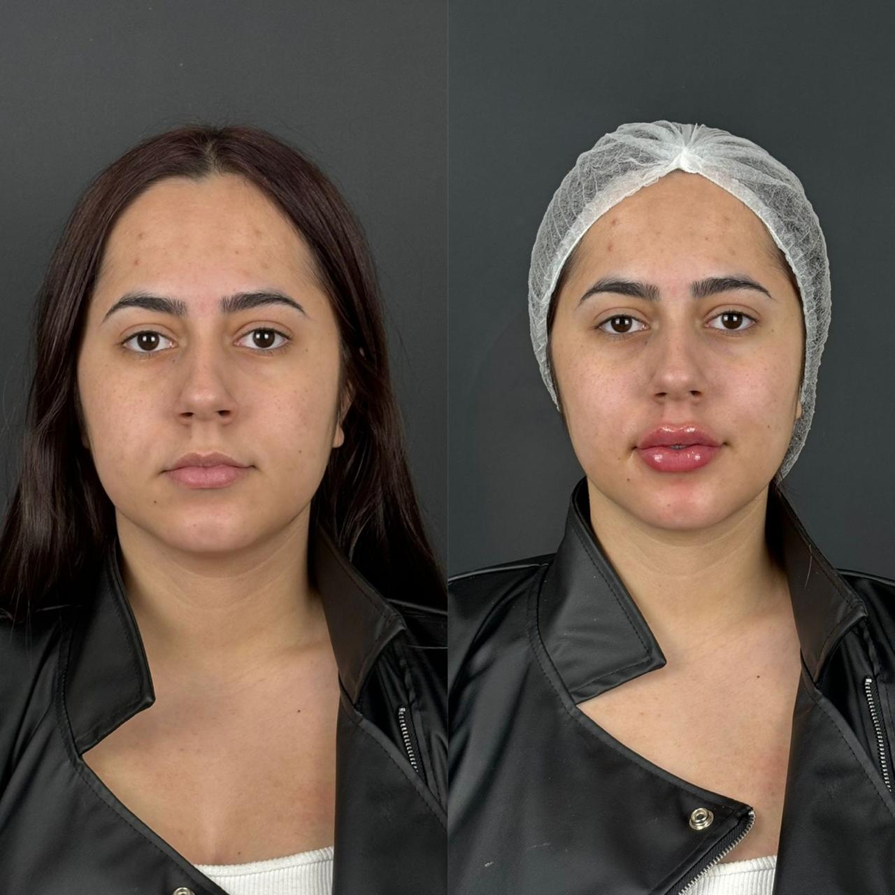 Aumento de Labios en Clínica Full Face