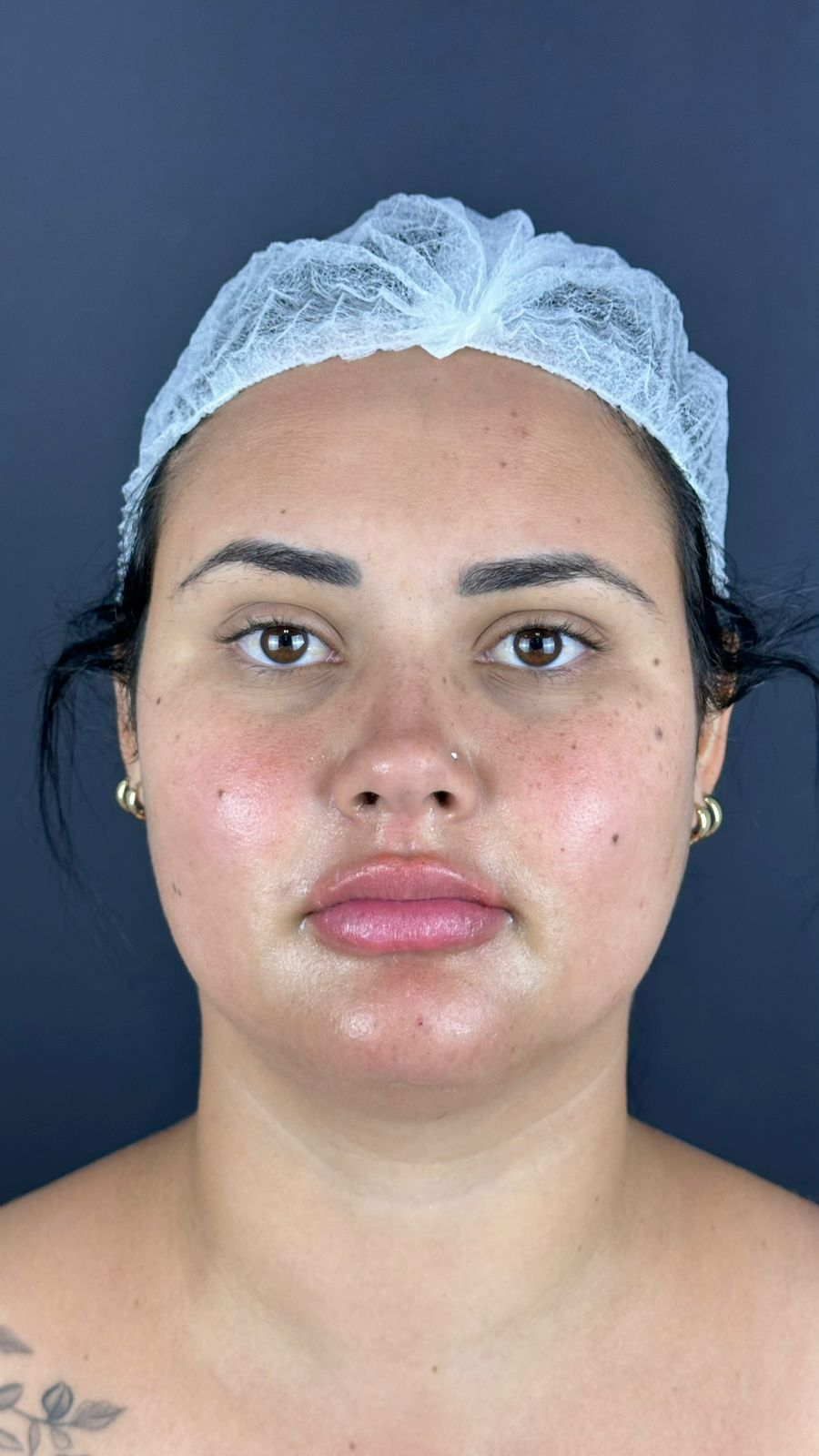 Después del tratamiento de armonización facial