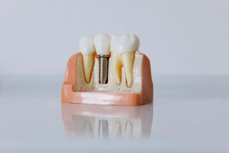 Implantología Oral en Clínica Full Face